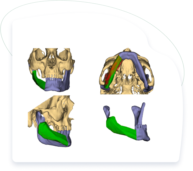 Facial Reconstruction