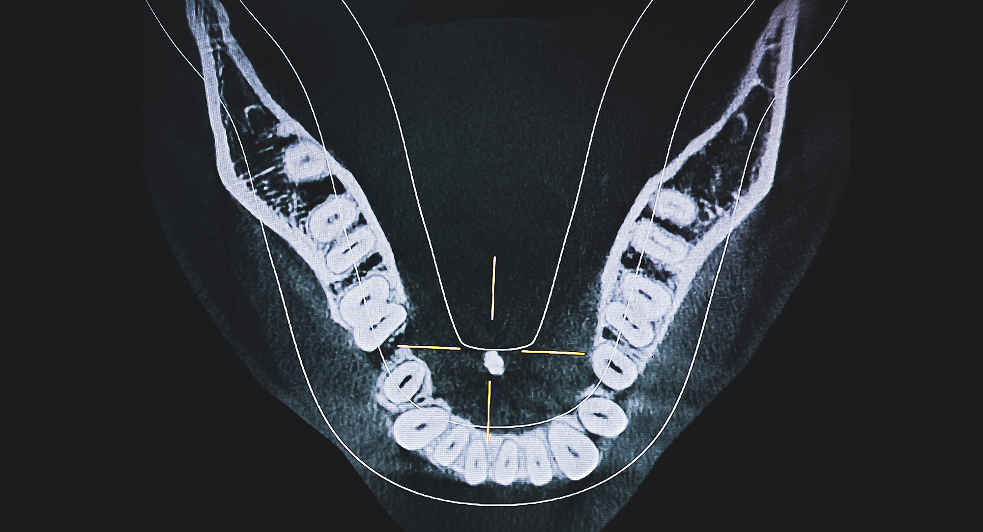 Salivary gland stone treatment Salivary gland stone Sialolithiasis Salivary duct obstruction Blocked salivary gland