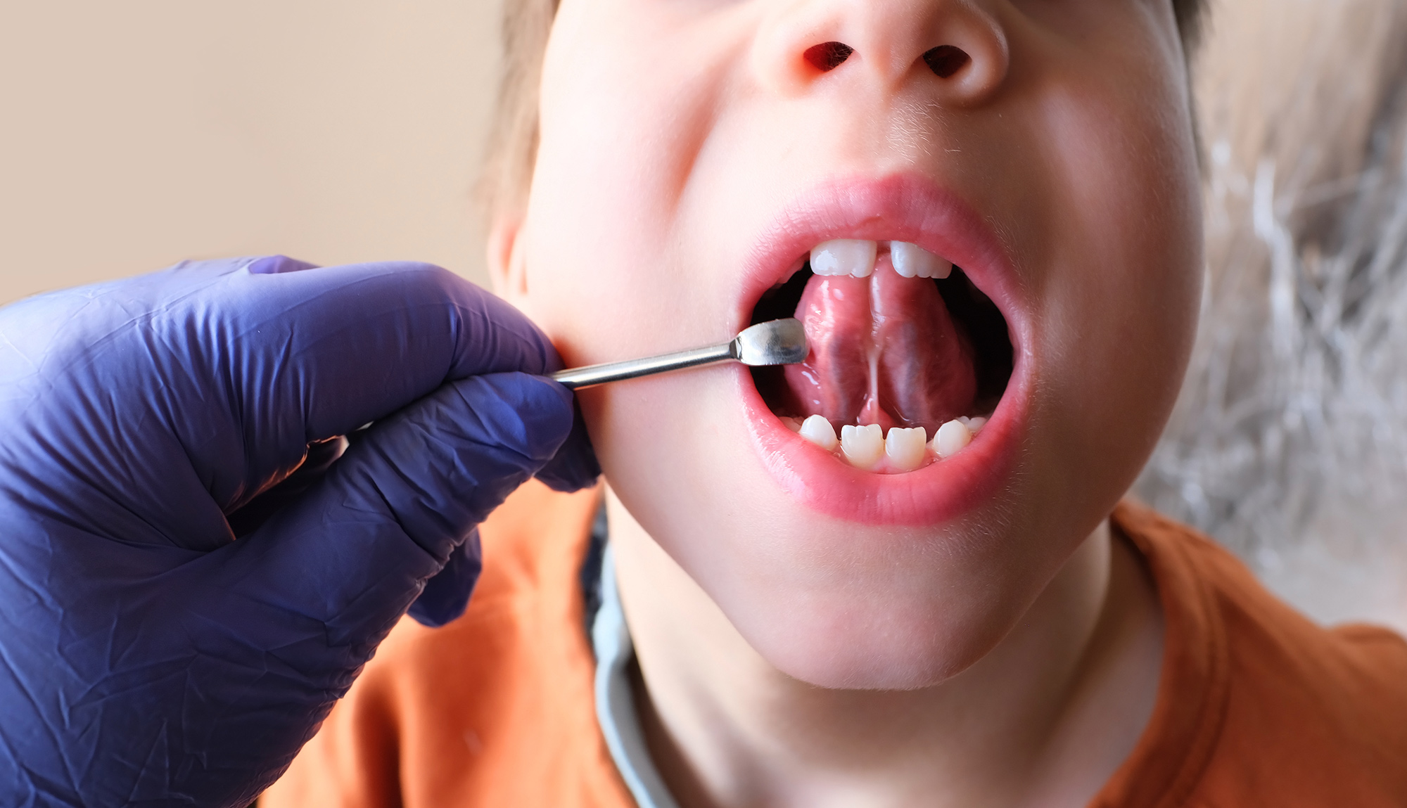 Tongue tie surgery Tongue tie treatment Tongue tie procedure Tongue tie release Frenectomy Frenuloplasty