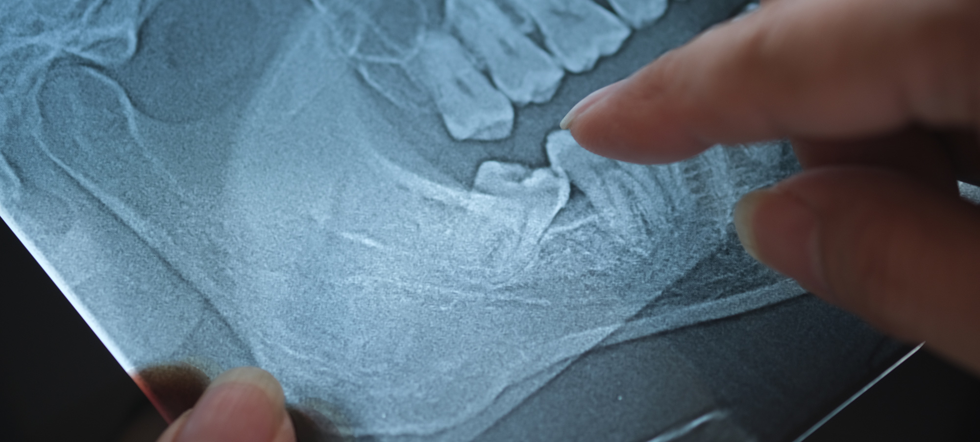 Wisdom teeth removal London Wisdom teeth removal Wisdom tooth extraction London Wisdom tooth removal Third molar extraction