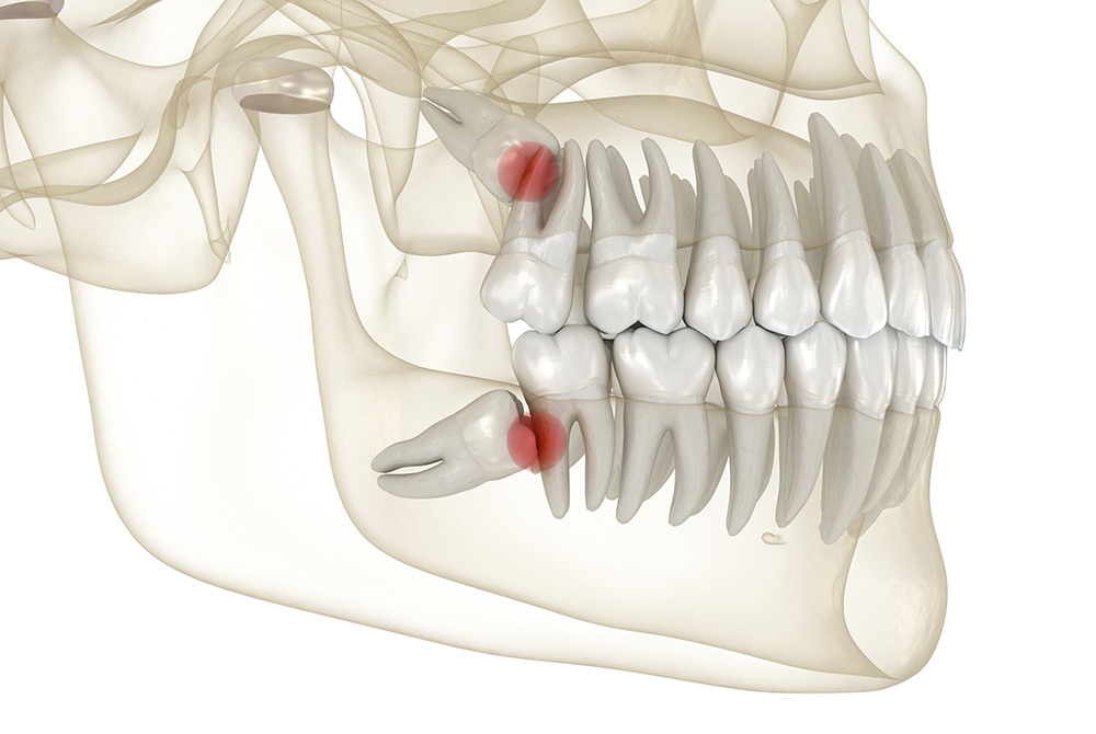 when do wisdom teeth need to be removed, wisdom tooth pain, swollen gums, wisdom teeth symptoms