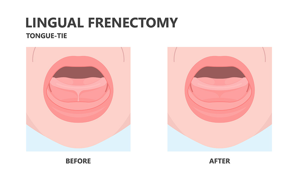 tongue tie in babies, feeding difficulties in babies, tongue tie symptoms in babies, infant feeding