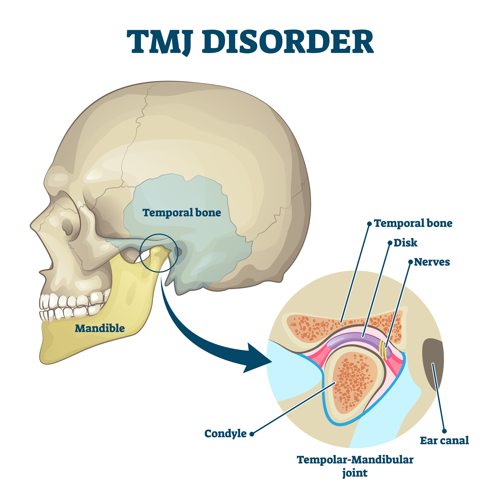 TMJ disorder, jaw pain, jaw clicking, TMJ symptoms, facial discomfort