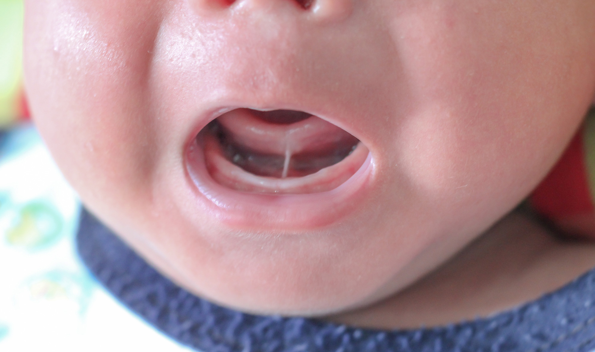 tongue tie in babies tongue tie baby tongue tie symptoms in babies tongue tie treatment