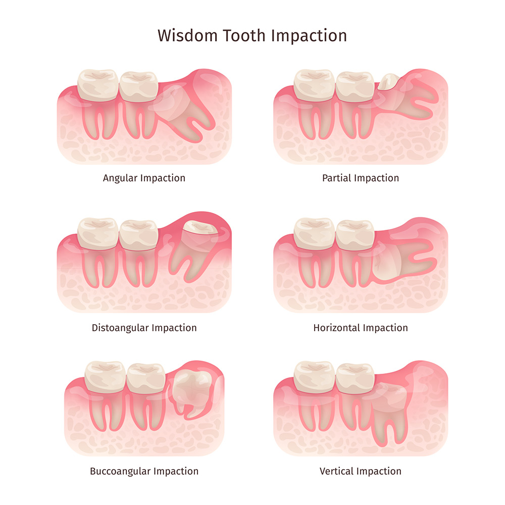 when do wisdom teeth need to be removed, impacted wisdom teeth, wisdom teeth pain, jaw pain