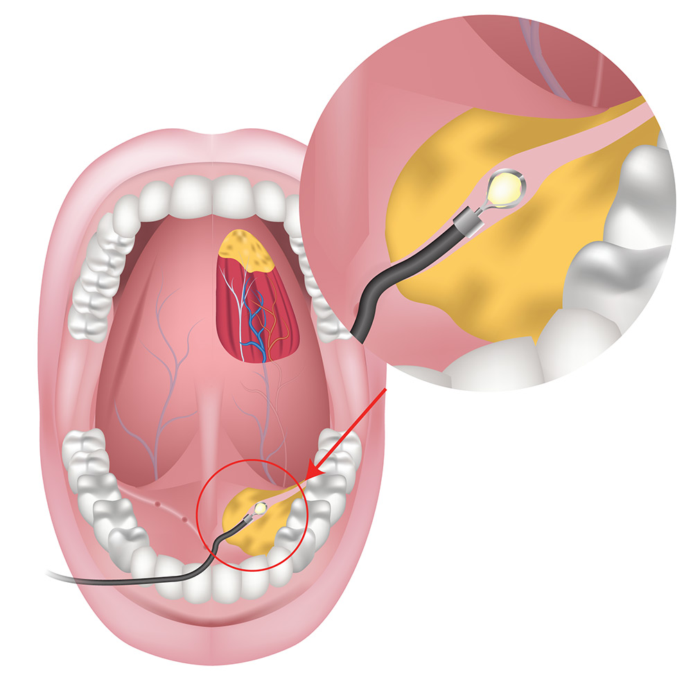 salivary gland stone symptoms, swelling under jaw, pain when eating, blocked salivary gland