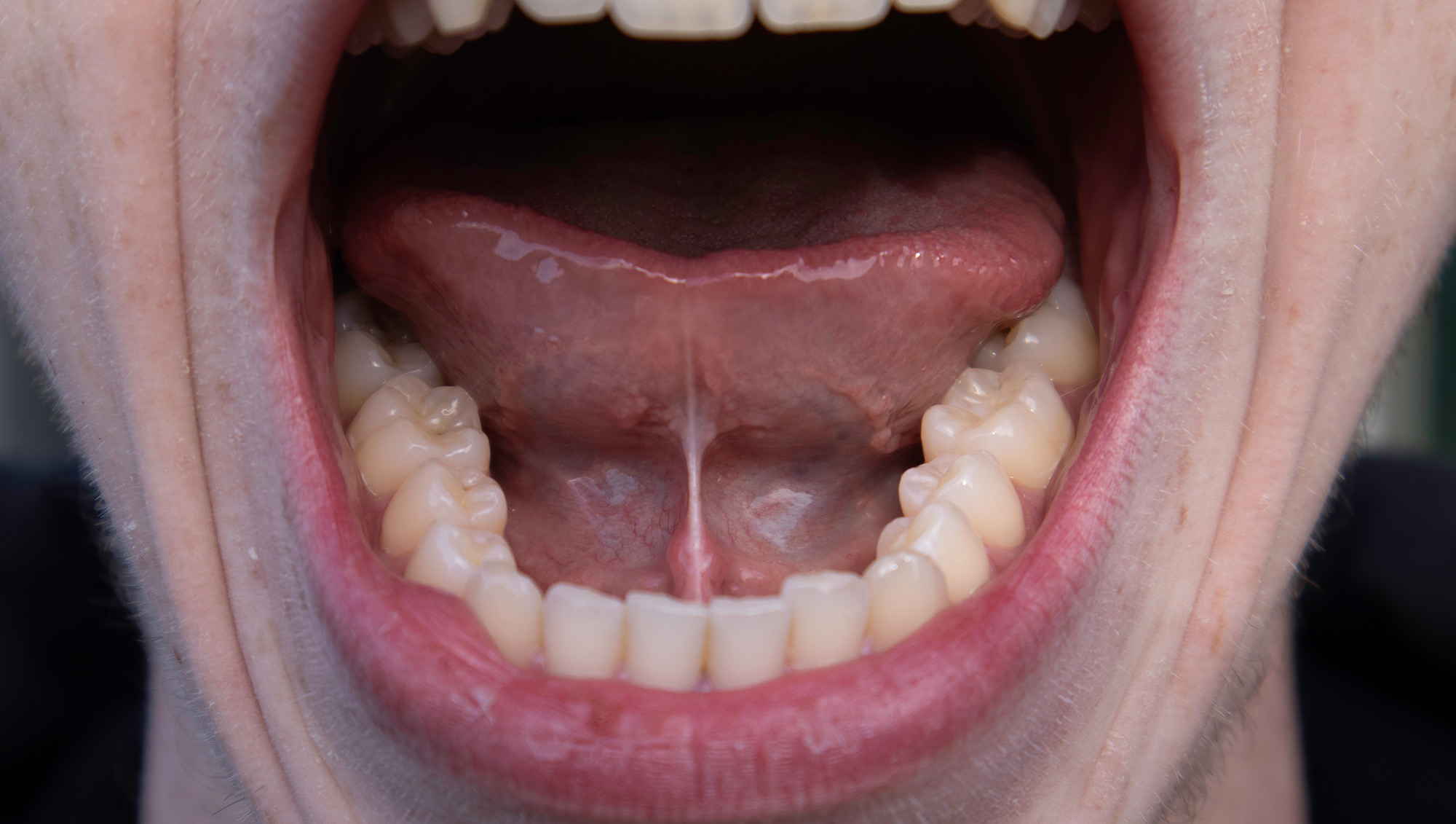 tongue tie in adults adult tongue tie tongue tie symptoms in adults tongue tie treatment adults