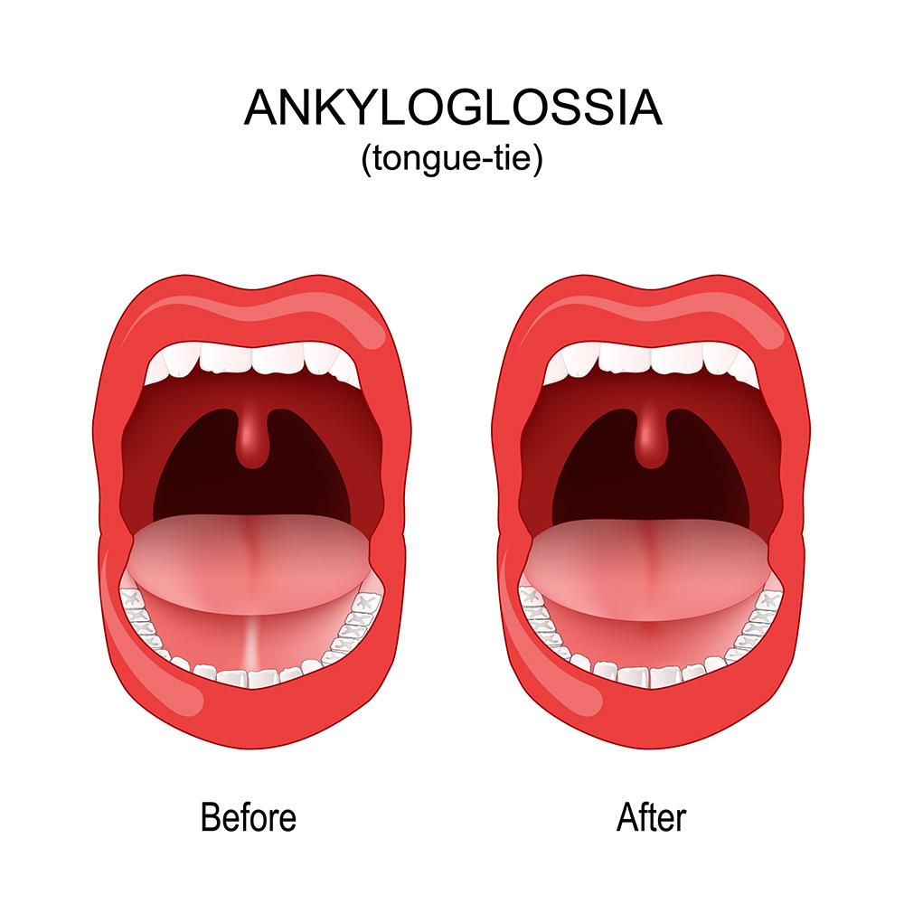 tongue tie in adults, restricted tongue movement, speech effort, oral function