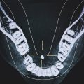 salivary gland stone symptoms salivary gland stones salivary gland stone blocked salivary gland