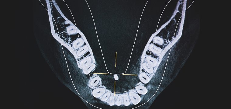salivary gland stone symptoms salivary gland stones salivary gland stone blocked salivary gland