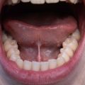 tongue tie in adults adult tongue tie tongue tie symptoms in adults tongue tie treatment adults