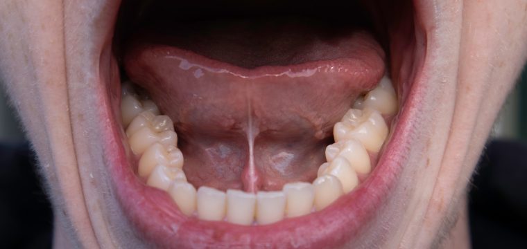 tongue tie in adults adult tongue tie tongue tie symptoms in adults tongue tie treatment adults