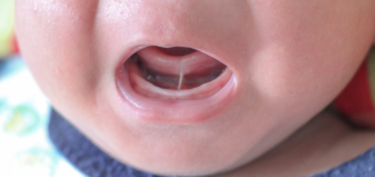 tongue tie in babies tongue tie baby tongue tie symptoms in babies tongue tie treatment