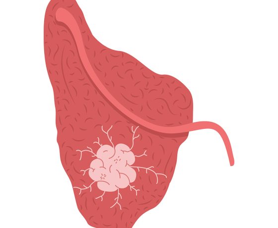 salivary gland tumour, benign salivary gland tumour, malignant salivary gland tumour salivary gland tumour, benign salivary gland tumour, malignant salivary gland tumour