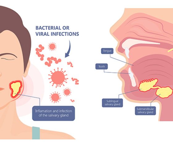 sialadenitis treatment, salivary gland infection, swollen salivary glands sialadenitis treatment, salivary gland infection, swollen salivary glands